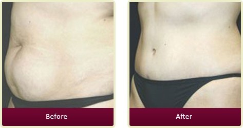 Tummy Tuck Orange County - Tummy Tuck Before and After