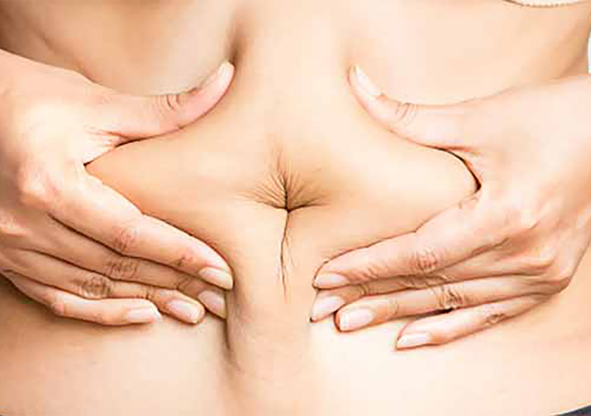 Tummy Tuck Treatment in Orange County Area