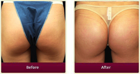 Before And After Results Of Brazilian Butt Lift Near Me In Huntington Beach, CA