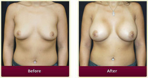 Breast Augmentation Surgery Orange County - Breast Augmentation Before and After