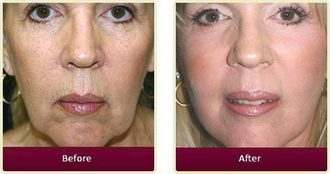 Before And After Results Of Facelift Near Me In Huntington Beach, CA